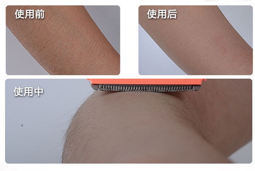刮除法脱毛
