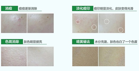 青春痘