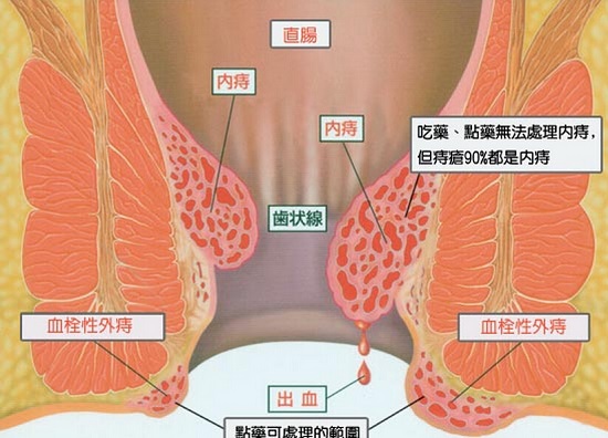 痔疮