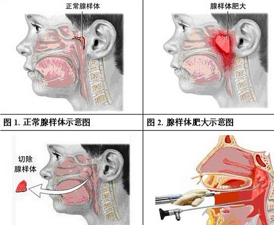 腺样体肥大