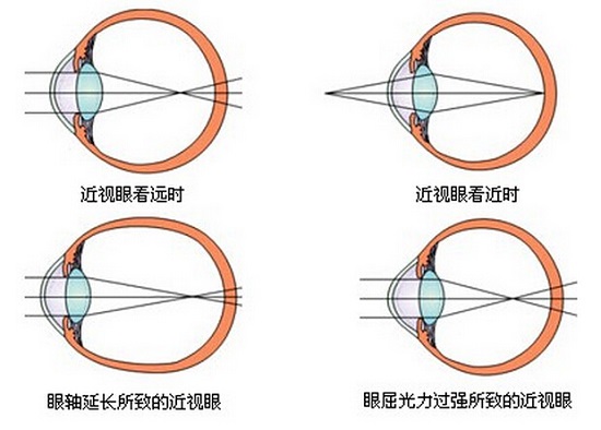 近视和远视