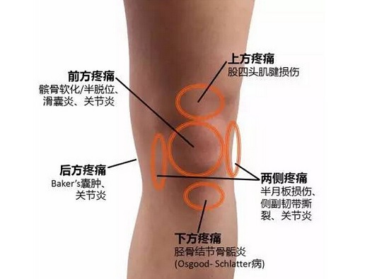 “跑步膝”现象