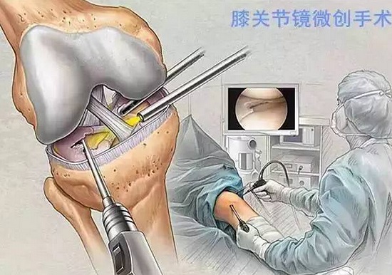 膝部手术