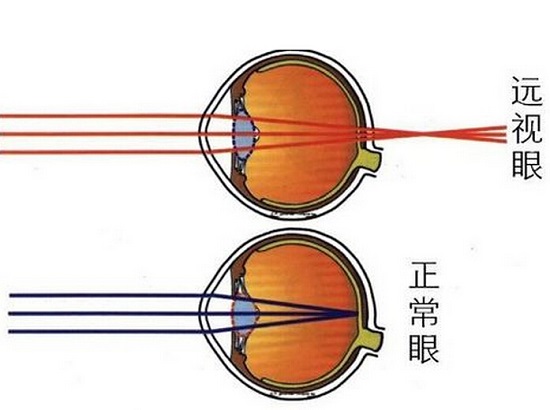 远视眼