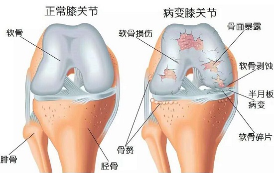 跑步膝