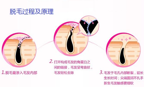 薇婷脱毛膏的脱毛原理