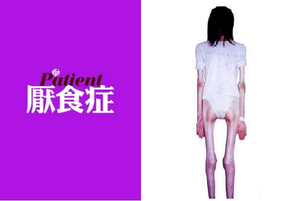可怕的厌食症