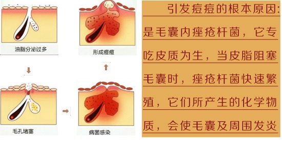 痤疮的起因