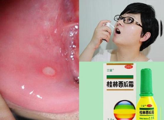 复发性口腔溃疡