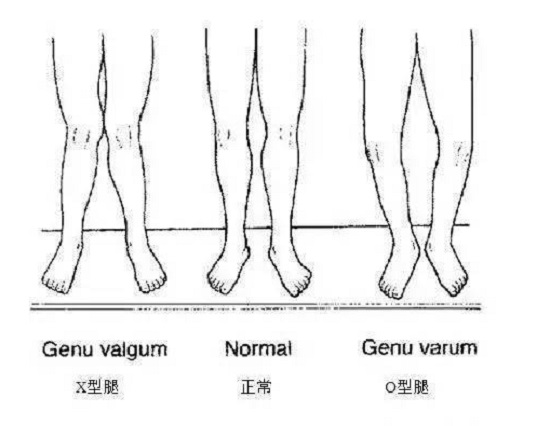膝关节畸型