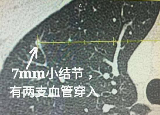 肺癌