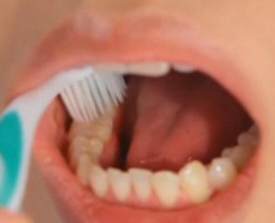 刷牙槽图片