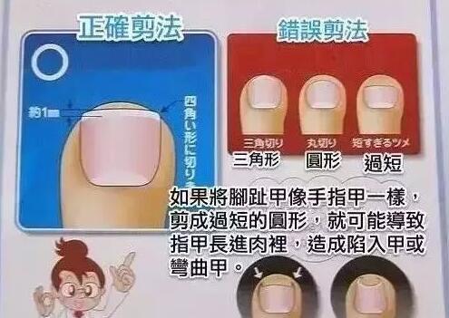 如何正确地修剪脚指指甲
