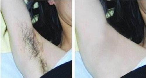 薇婷脱毛膏使用感受