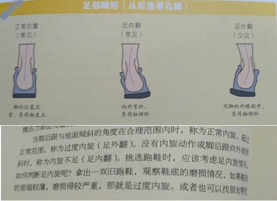 足部静态排列错乱