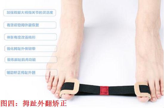 脚趾畸形矫正