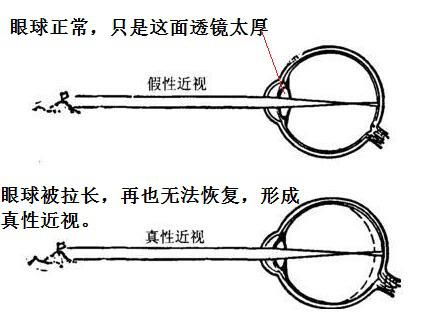 假性近视与真性近视