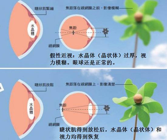 假性近视的恢复与治疗原理
