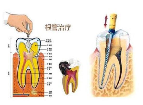 根管治疗