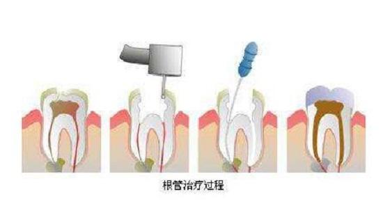 根管治疗