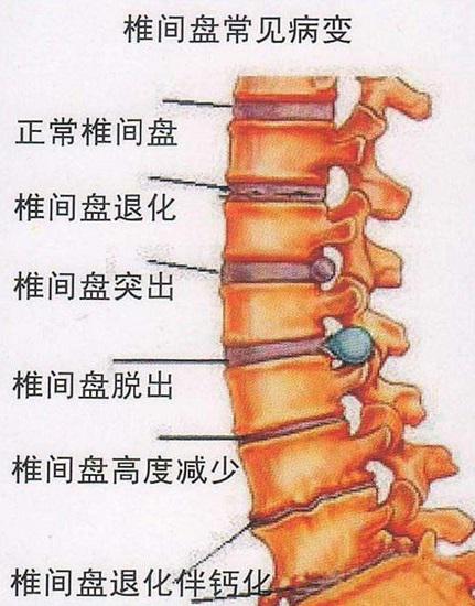 常见的腰椎疾病