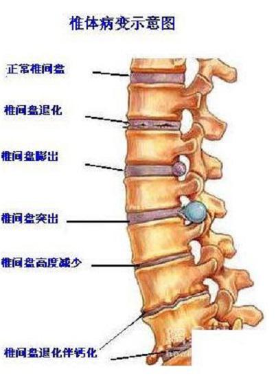 椎体病变示意图