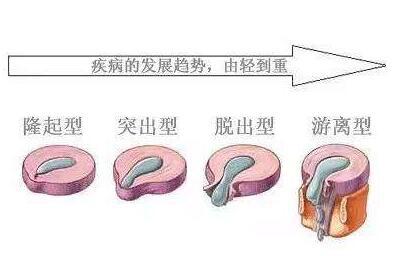 腰椎间盘突出的不同症状