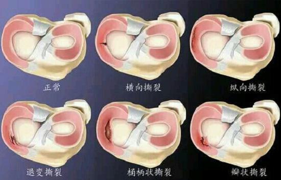半月板（纵切图）