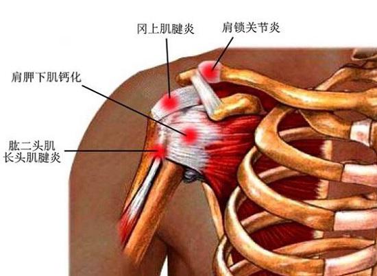 肱二头肌的无菌性炎症