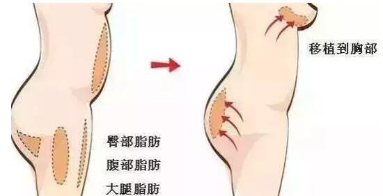 自体脂肪填充术原理