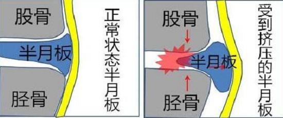膝关节损伤