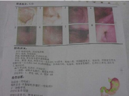 胃镜检查