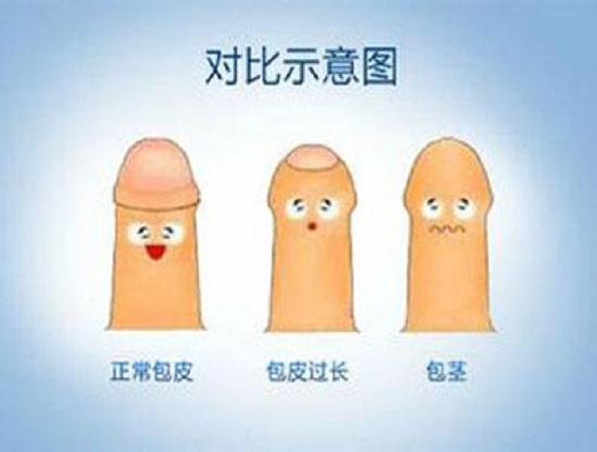 包茎