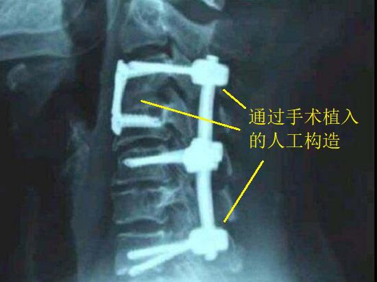 颈椎病手术治疗后的情况