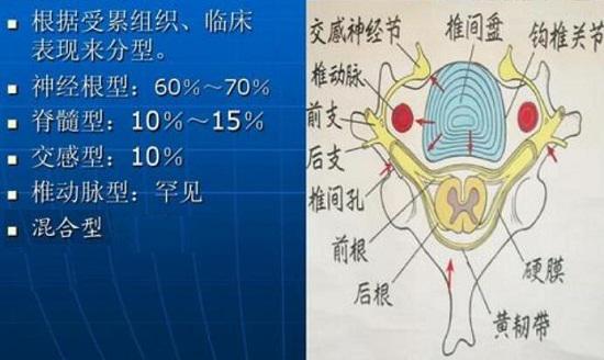 颈椎剖面及颈椎病的类型