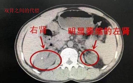 肾脏之间的功能代偿
