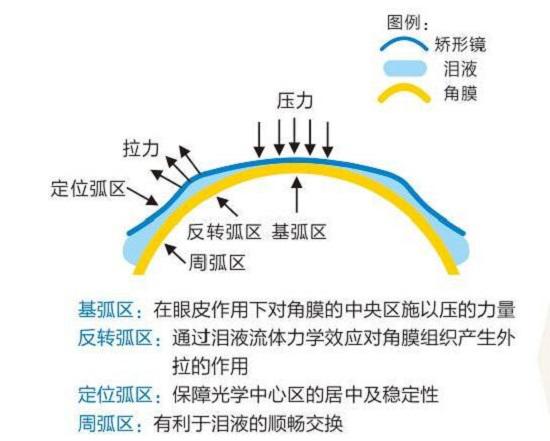 角膜塑形镜的工作原理