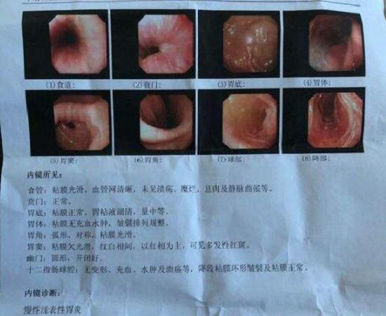 胃镜检查报告