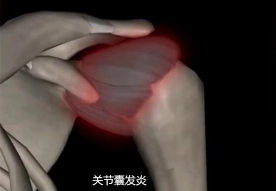 关节囊发炎