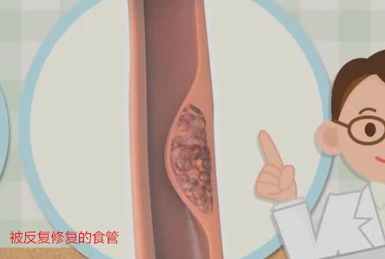 被反复修复的食管