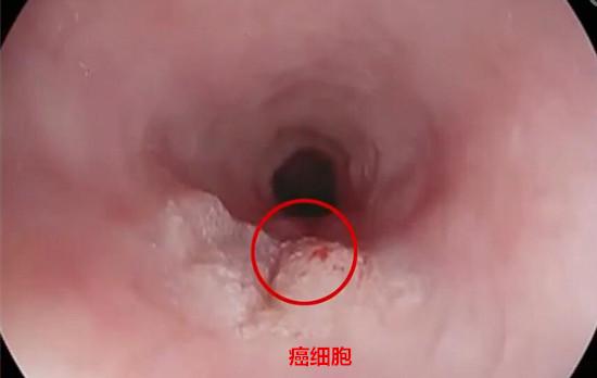 食管癌