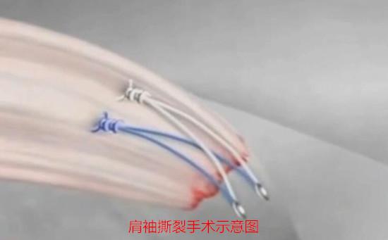 肩袖撕裂手术示意图