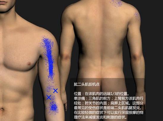 肱二头肌扳机点