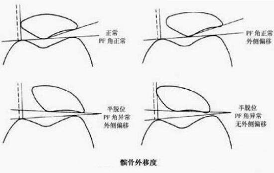 髌骨及其在股骨上的“滑轨”
