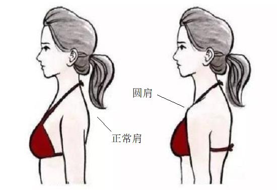 圆肩现象