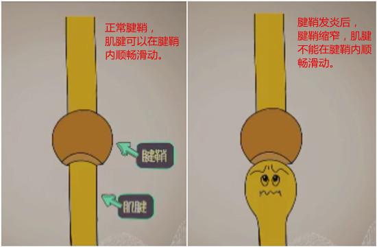 发病示意图