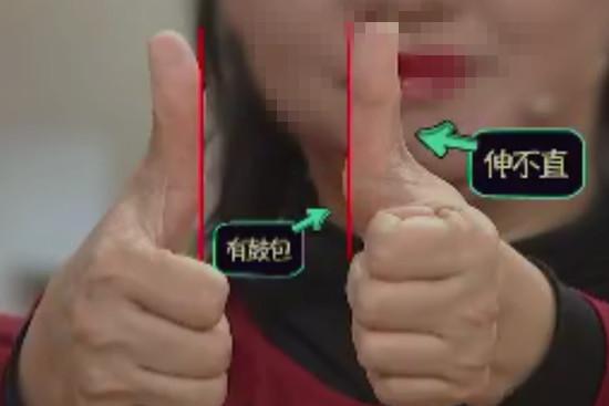 两侧手指伸直情况不同