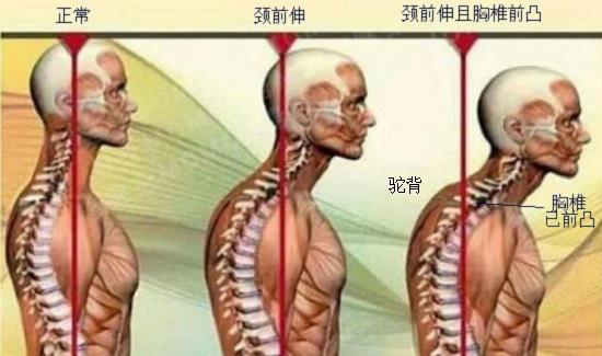 逐步恶化的脊柱前伸现象