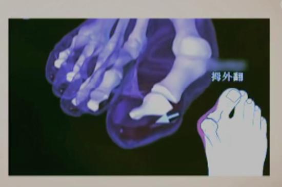 拇外翻