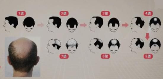 秃发过程